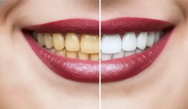 Does Teeth Whitening Damage Enamel? What Parents Need to Know