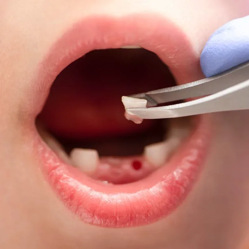 Pediatric tooth extraction procedure
