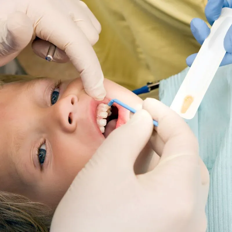 Child smiling after a fluoride varnish application at Bite Squad Dental of NYC