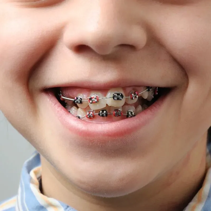 Space maintainer for missing baby teeth