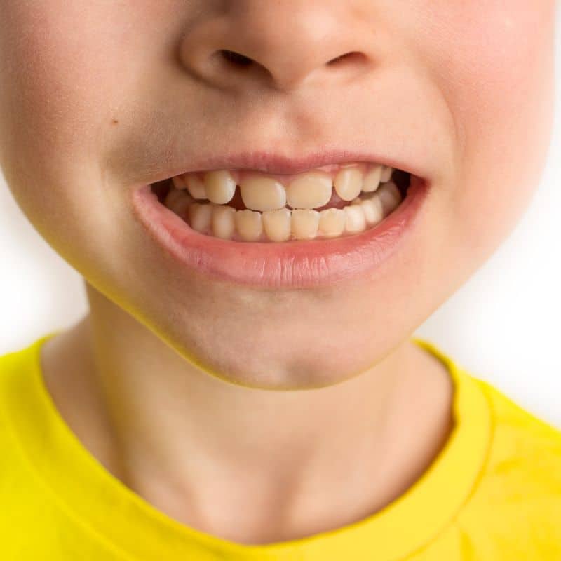Teeth grinding (bruxism) in children