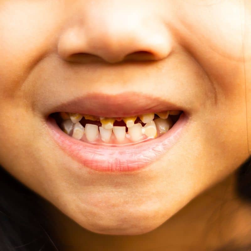 Pediatric gum disease examination