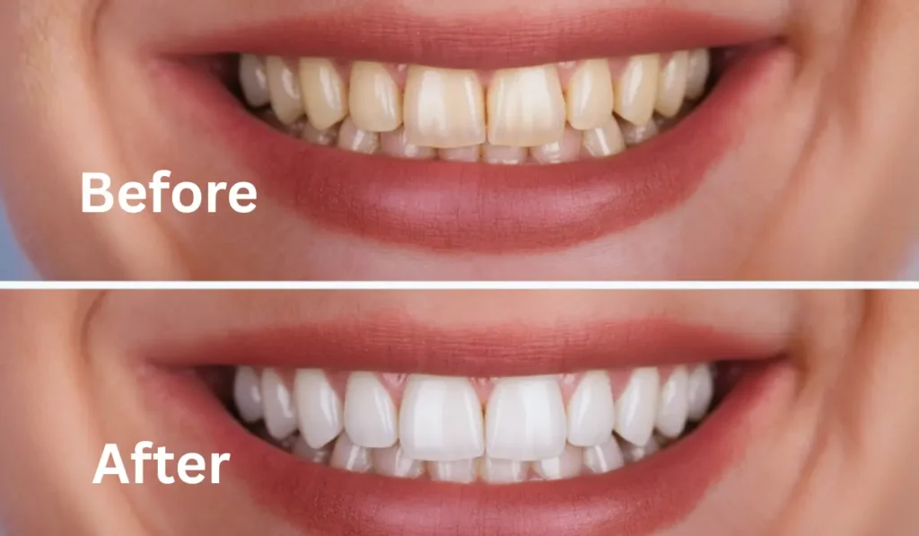 Before and after comparison of professional results to help evaluate teeth whitening cost and effectiveness.