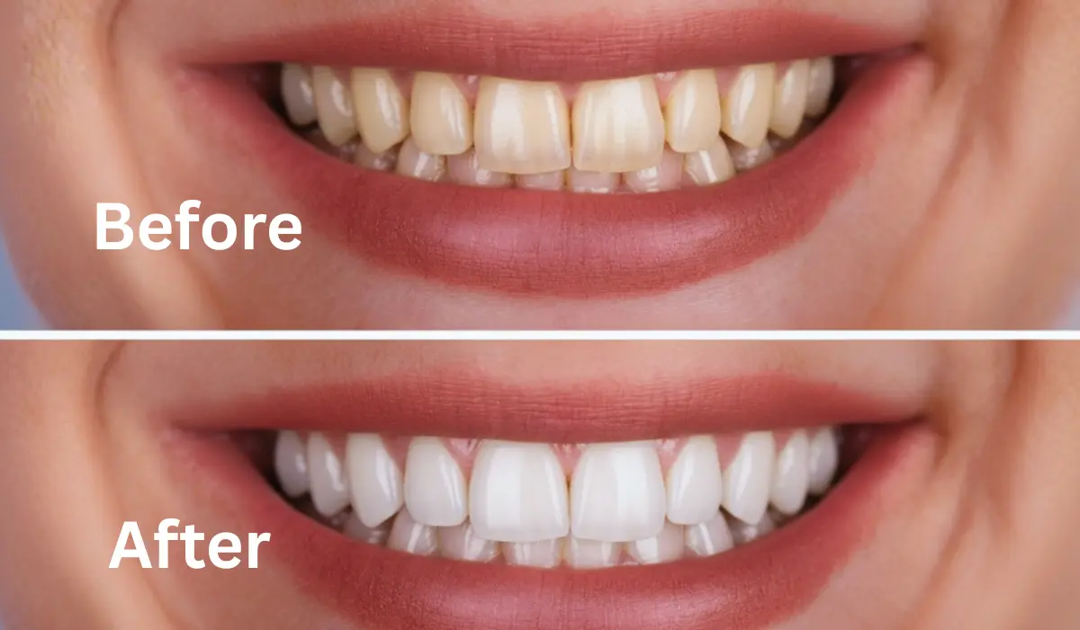 Before and after comparison of professional results to help evaluate teeth whitening cost and effectiveness.