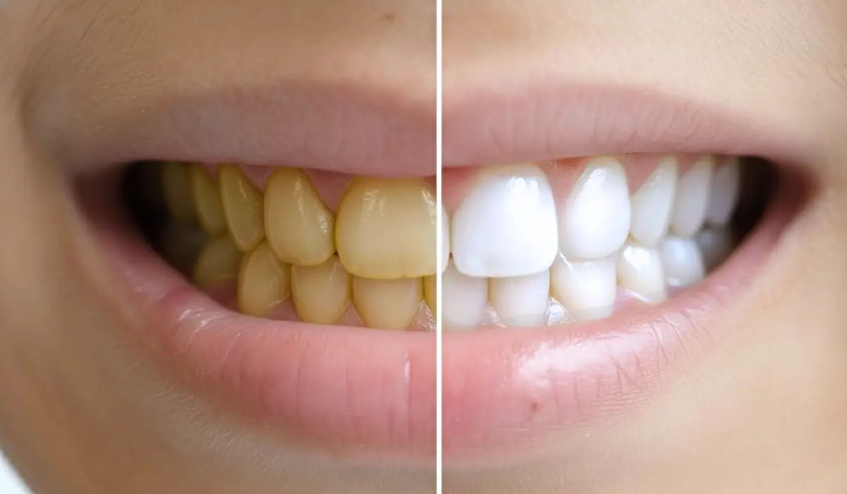 A side-by-side comparison of a child's smile showing yellow teeth vs. bright white teeth, illustrating the results of when a child get teeth whitening.